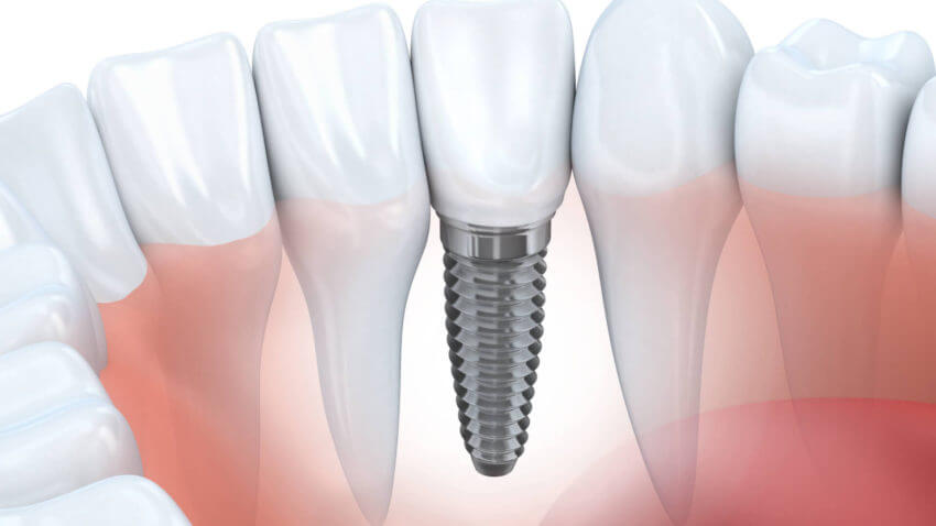 Single Tooth Dental Implants Las Vegas