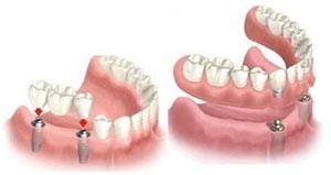 Lasting Smiles Dental Care Las Vegas, NV dental implants for replacing missing teeth