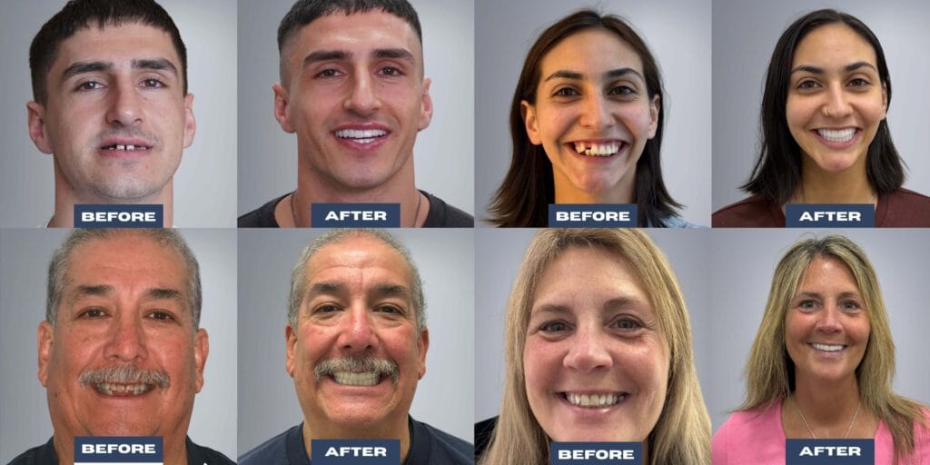 All-on-4 vs All-on-6 vs All-on-X full-arch dental implants comparison