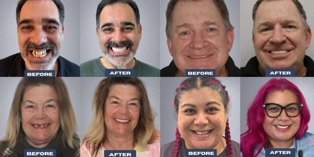 Full mouth dental implant transformations using advanced digital technology for permanent tooth replacement.