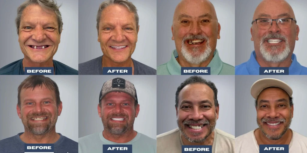 Dental Implant for Seniors before and after photos smiling Dental implant for seniors designed to replace missing teeth with a stable, natural-looking smile.