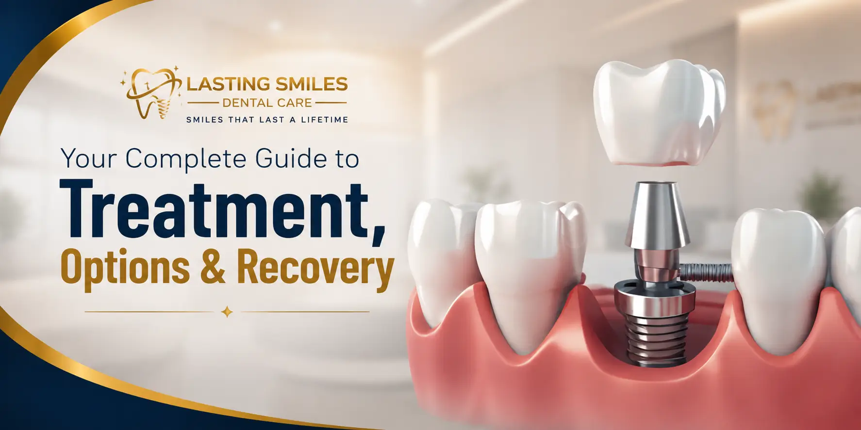 Featured image for “Dental Implant: Complete Guide to Treatment, Options, and What to Expect”