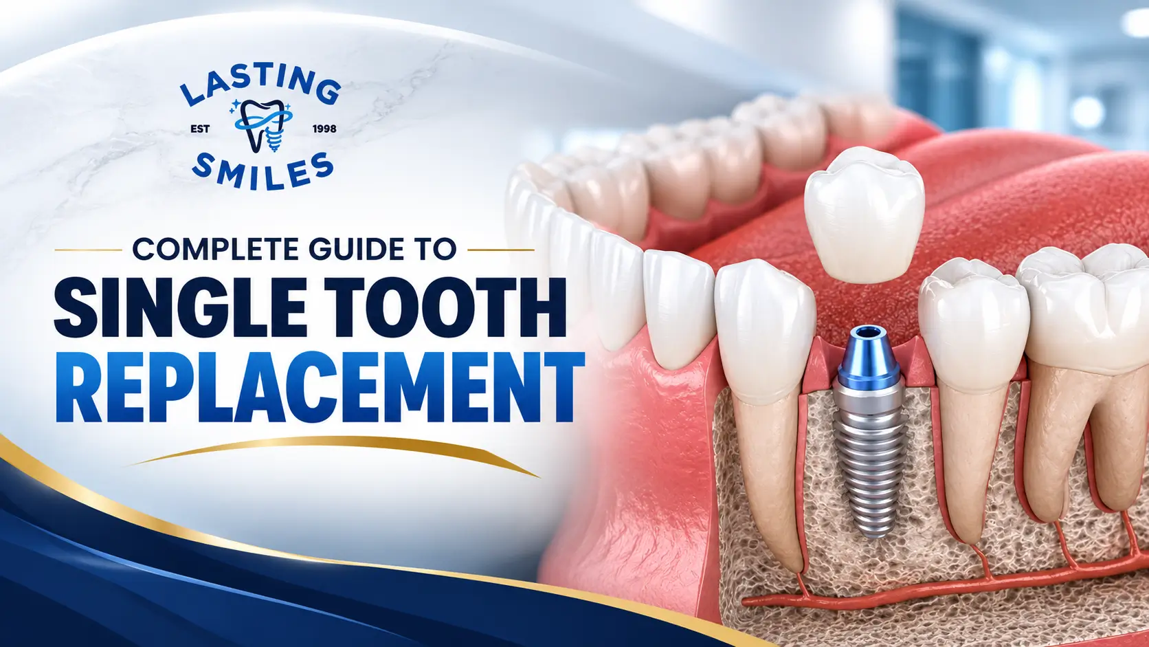 Featured image for “What is a Single Dental Implant: Complete Guide to Single Tooth Replacement”