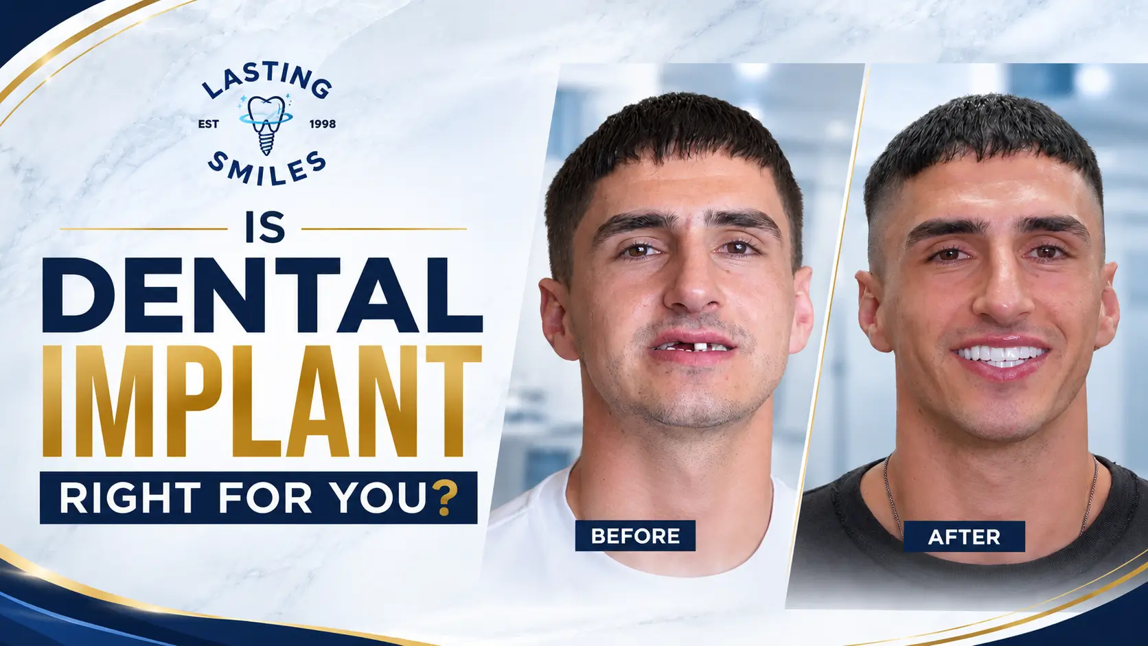 Featured image for “Is Dental Implant Right for You? Everything You Need to Know Before Replacing Missing Teeth”