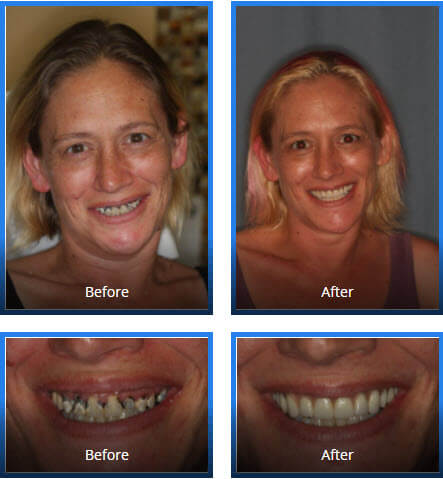 Before and After photos of a female that underwent Cosmetic Dentistry Procedures