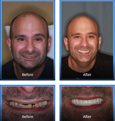 Male patient before and after all on 4 dental implant photos