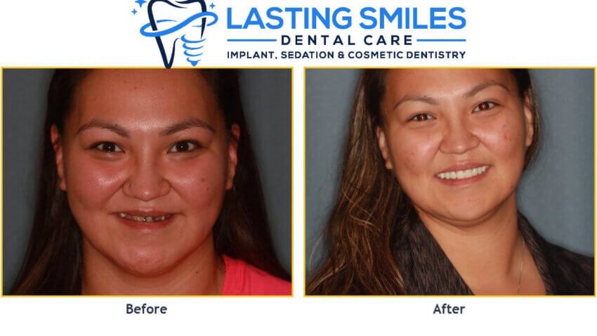 Before and after photos of a female dental implant patient