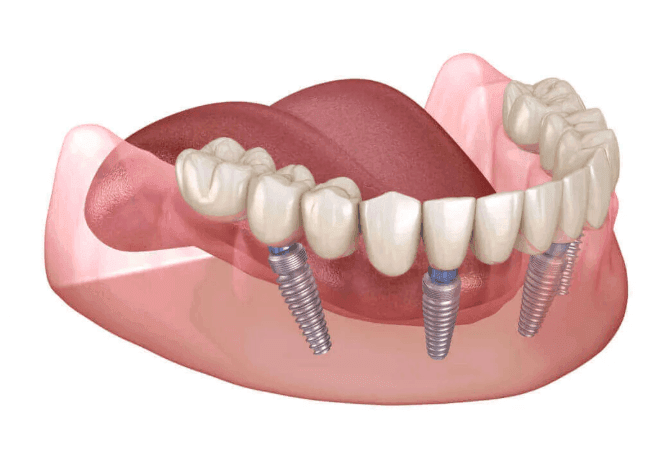 Full Arch Dental Implants for Seniors