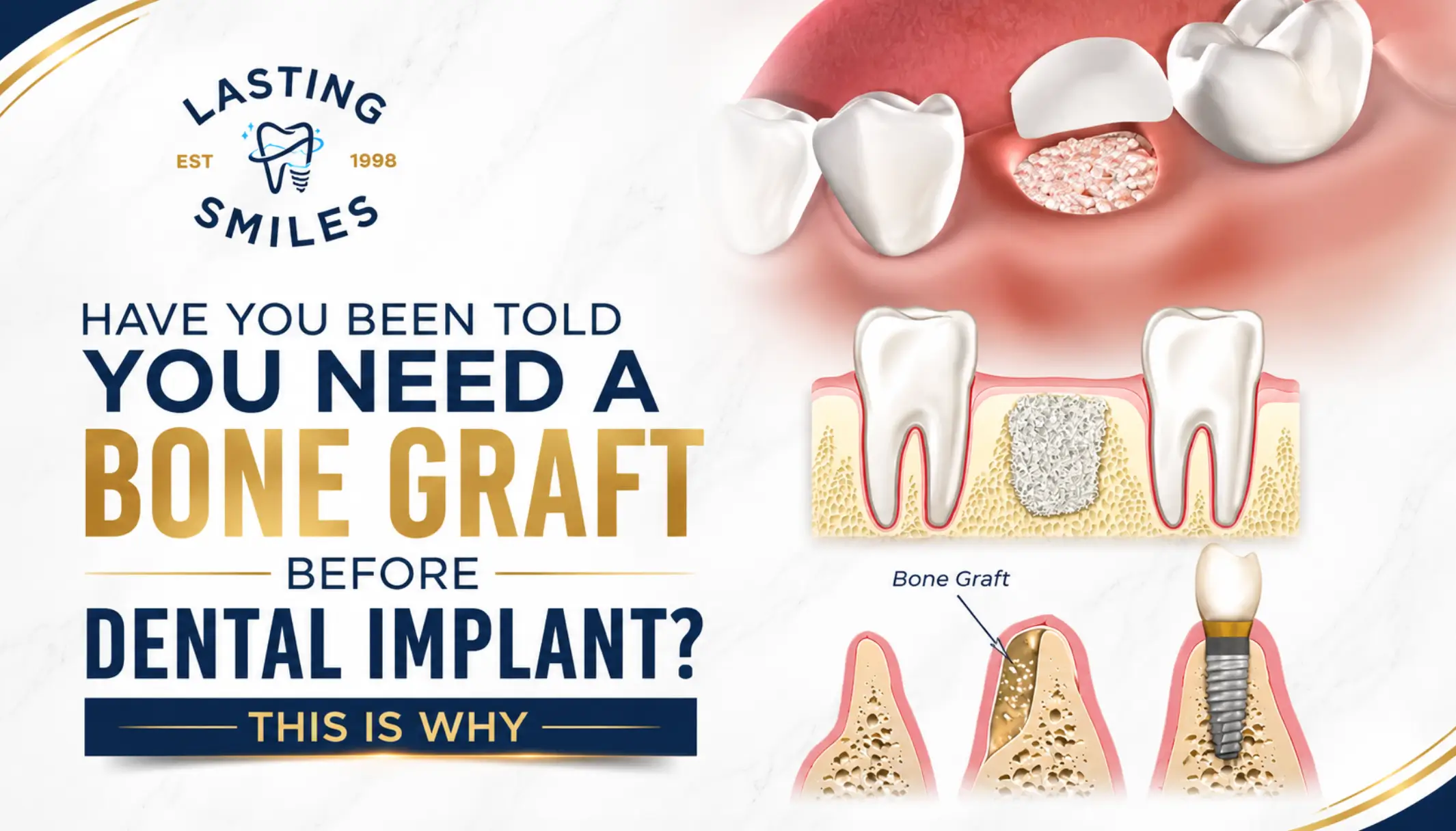 Featured image for “Bone Graft for Dental Implants in Las Vegas: Rebuilding Your Foundation for a Permanent Smile”