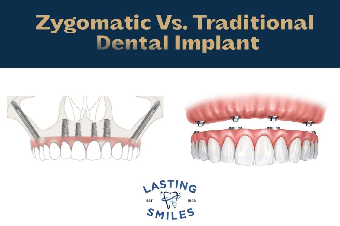 Zygomatic Dental Implants - Lasting Smiles