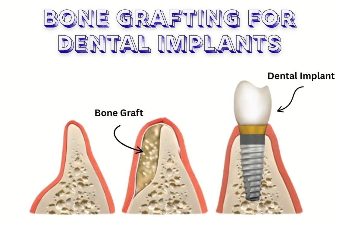 Featured image for “Bone Grafting for Dental Implants in Las Vegas: Rebuilding Your Foundation for a Permanent Smile”