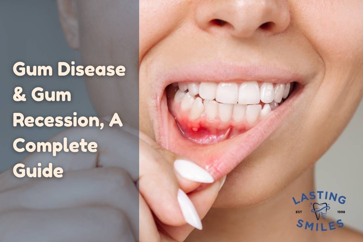 Gum diseas - Lasting Smiles