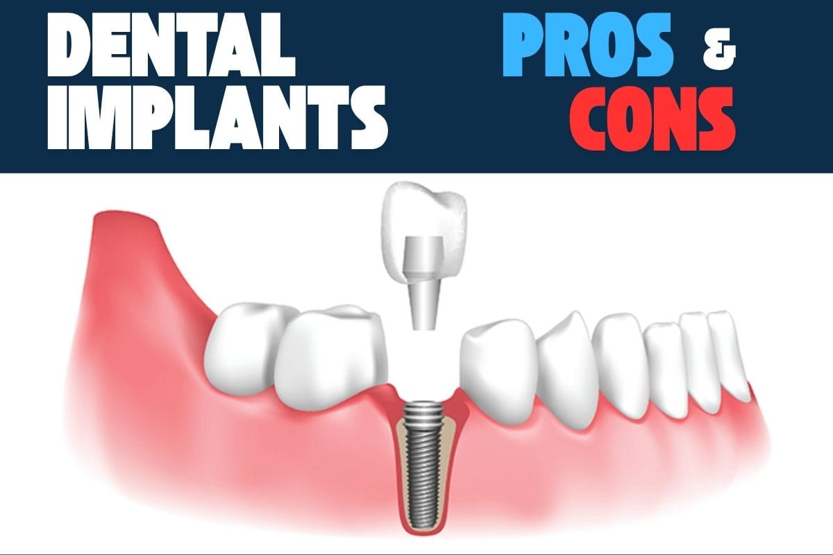pros and cons of dental implants - Dental Implants