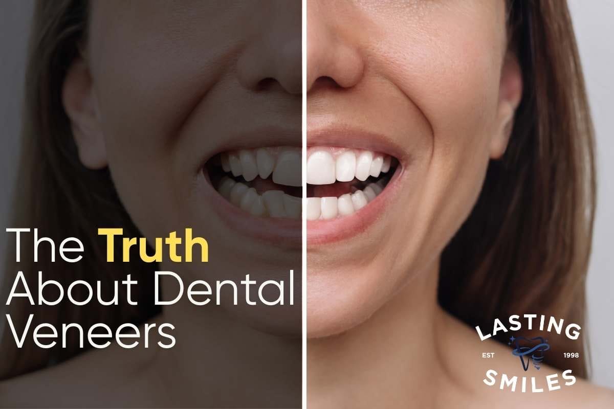 Featured image for “Do Veneers Damage Your Teeth? What You Need to Know Before Getting Veneers”