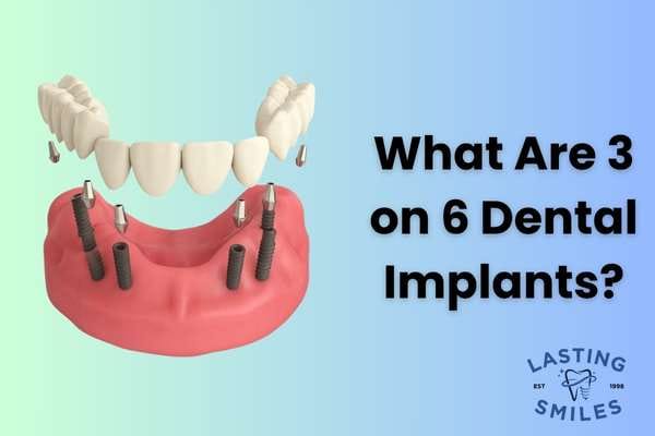 3 on 6 Dental Implants - Lasting Smiles