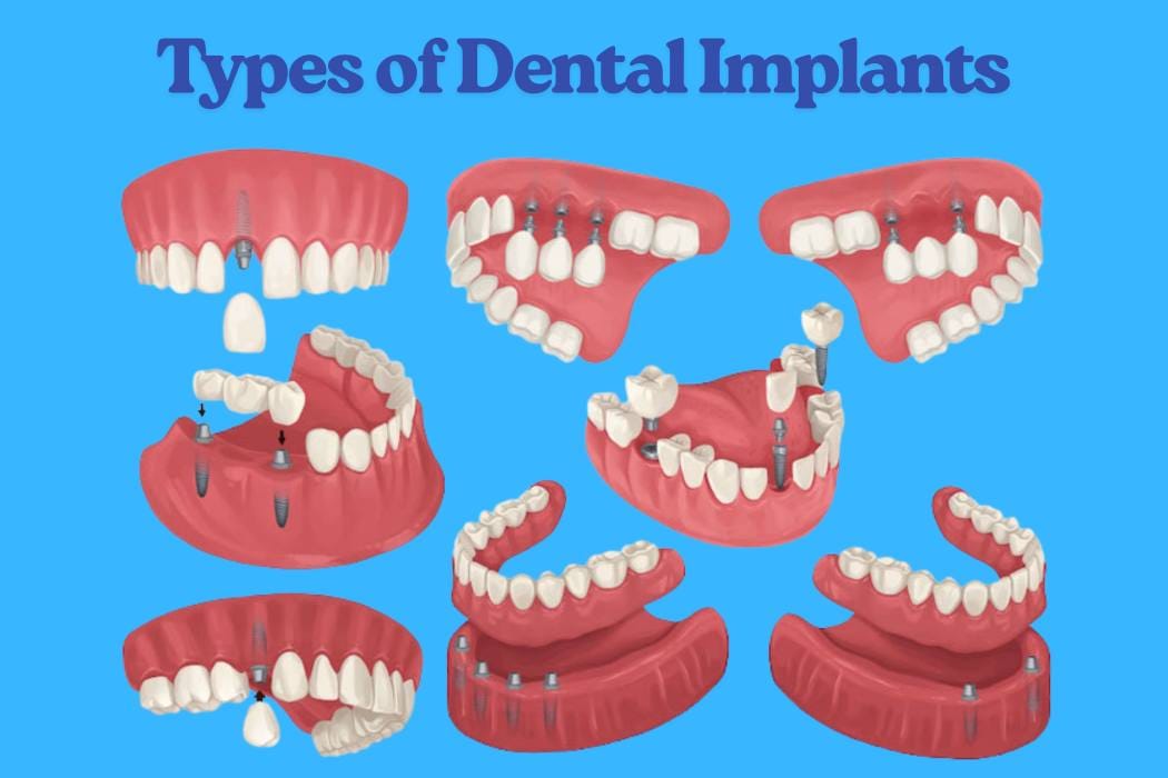 types of dental implants