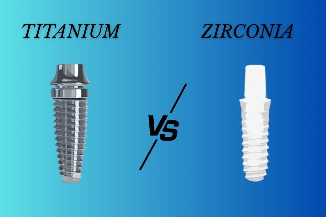 Titanium vs. Zirconia Dental Implants - Lasting Smiles