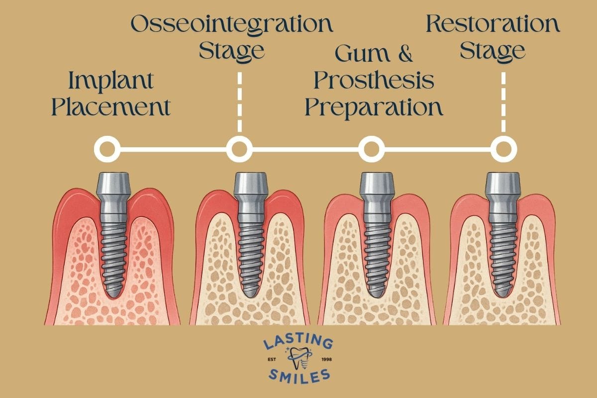 Featured image for “Understanding the Dental Implant Healing Stages: What to Expect & How to Care”