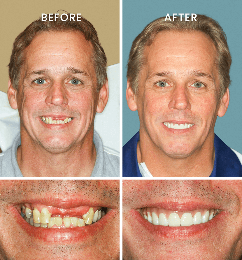 Before and after full mouth dental implants results with flexible teeth payment plan options at Lasting Smiles