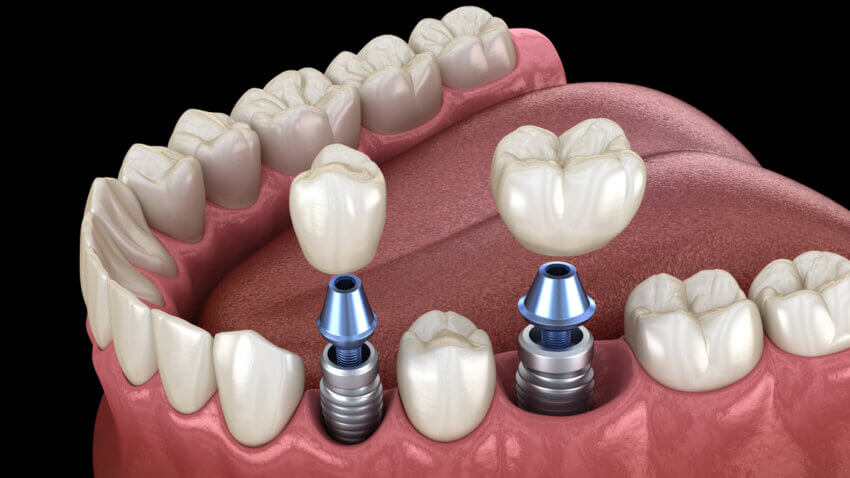 Premolar and Molar tooth crown installation over dental implant, screw fixation. 3D illustration of dental treatment