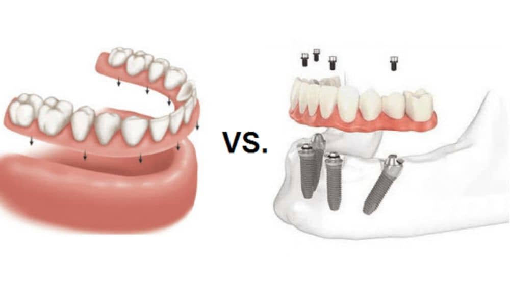 dental implant vs. denture