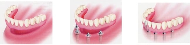 denture prices options