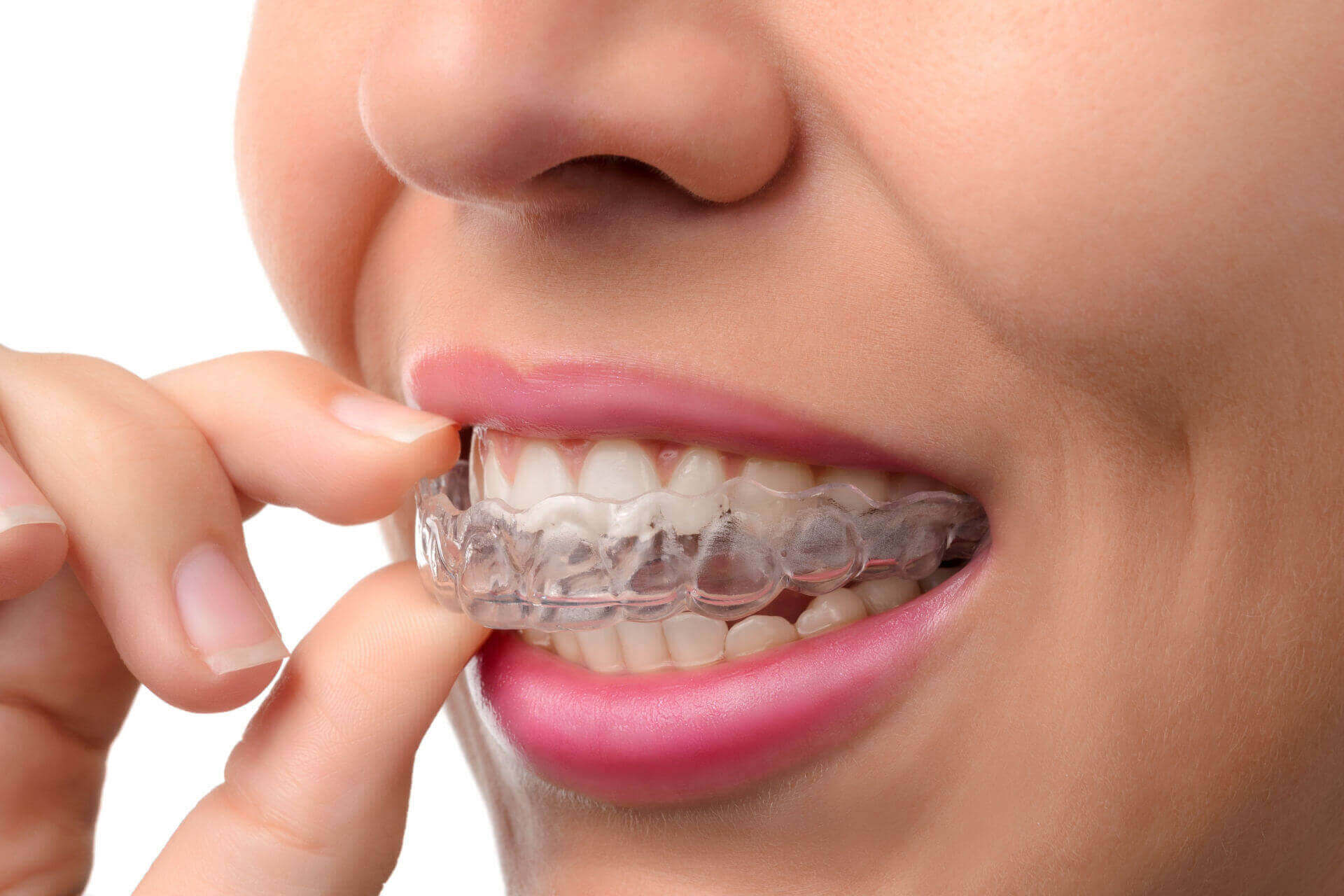 Lasting Smiles Dental Care Invisalign placed in mouth of young woman