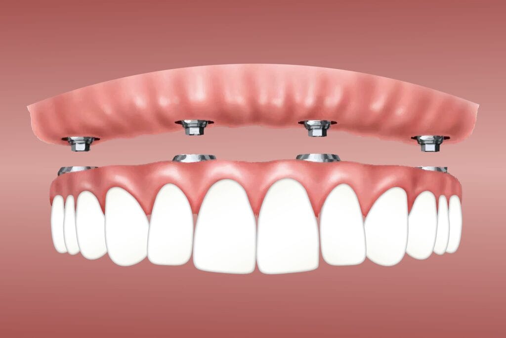 All-on-X Dental Implant at Lasting Smiles